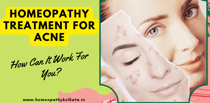 homeopathy treatment for acne